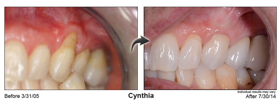 Glendale gum rejuvenation