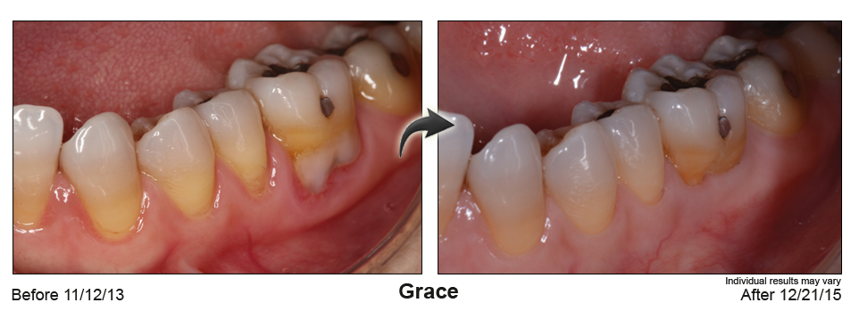 fix gum recession Glendale