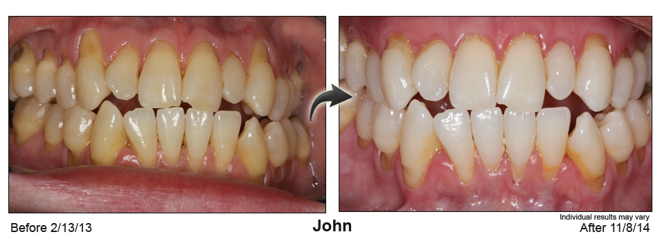 Glendale gum recession