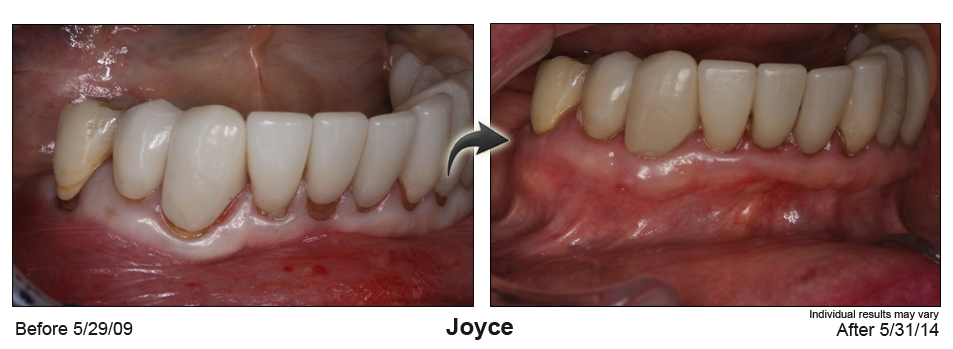 pinhole gum rejuvenation Glendale