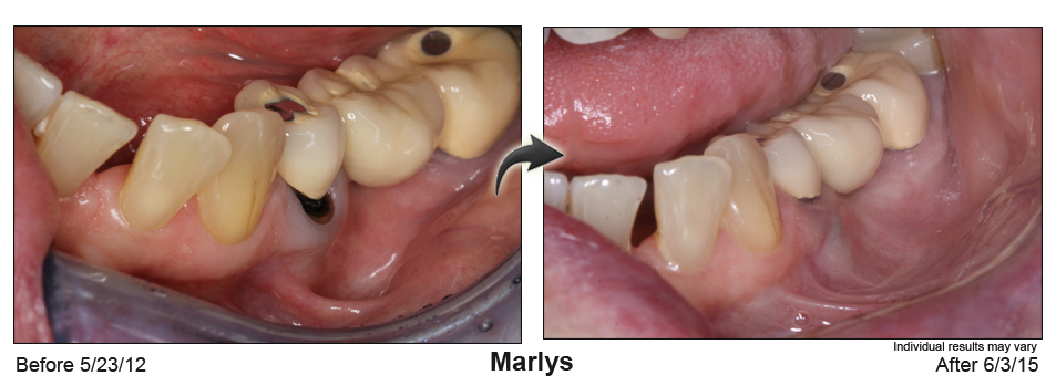 pinhole surgical technique dentist Glendale