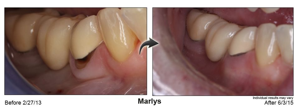 fix receding gums Glendale